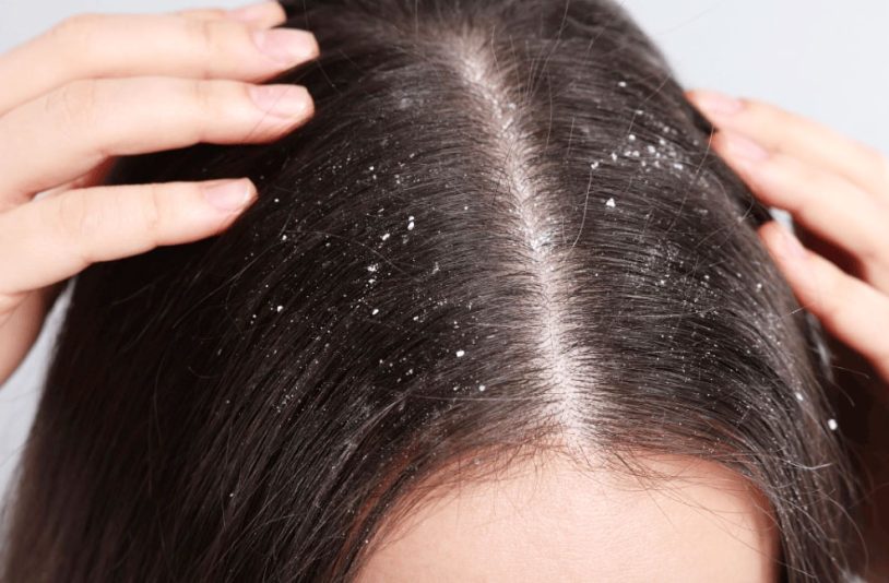 dandruff